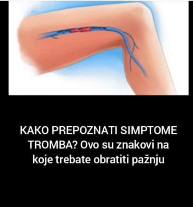 KAKO PREPOZNATI SIMPTOME TROMBA? Ovo su znakovi na koje trebate obratiti pažnju: Kada se krvni ugrušak nađe u blizini srca javljaju se sljedeći simptomi